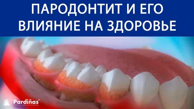 ᐈ Периодонтит и Пародонтит: 6 важных отличий и характерные признаки