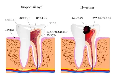 Кариес, пульпит и периодонтит: в чем разница? Рассказывают стоматологи  «АксисДент»