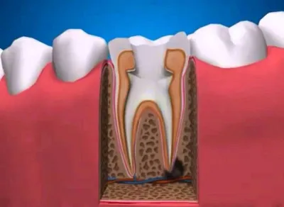 Лечение зубного хронического периодонтита в Днепре - Дентал Евро