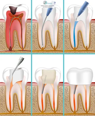 Хронический периодонтит зубов: причины, симптомы и лечение