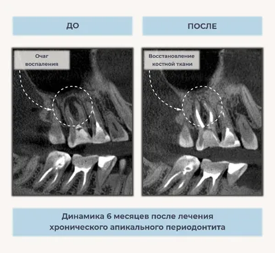 Лечение периодонтита - Стоматологическая клиника в москве - «Интерстом»