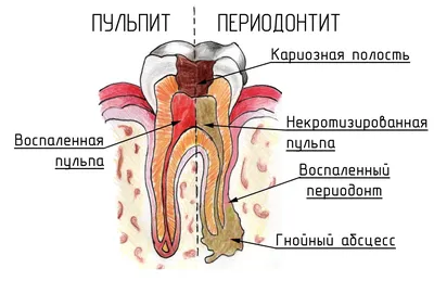 Лечение периодонтита. Екатеринбург, Стоматологическая клиника Дента Ви