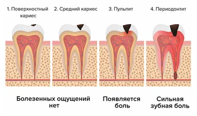 Лечение периодонтита зуба в Минске, цена комплексного лечения каналов  периодонтита