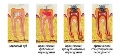 Хронический периодонтит зубов: причины, симптомы и лечение