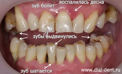 Периодонтит — тактика лечения. | ВКонтакте