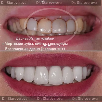Фото комплексного лечения зубов до и после - портфолио стоматологи «Венеция  Дент»