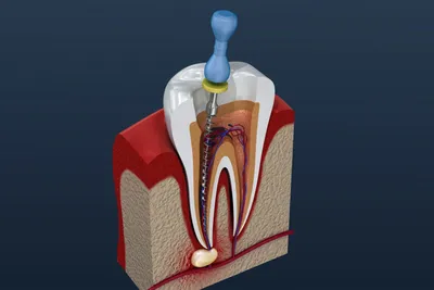 Raffa-Dent - ДО И ПОСЛЕ 💥⠀ ⠀ У пациентки хронический апикальный периодонтит  12, 11з.⠀ Кариозные полости находятся под десной на 2 мм.⠀ В 13 зубе  медиальной и дистальной полости( между 11 и