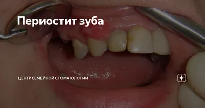 Лечение периостита челюсти и зуба| Виды, причины и профилактика периостита
