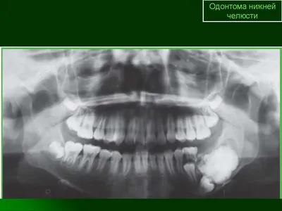 Периостит зуба | Центр Семейной Стоматологии | Дзен