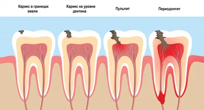 Лечение периостита в Мосвке в стоматологии Балестом | метро (Царицыно,  Орехово)