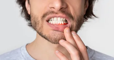 Лечение периостита челюсти и зуба| Виды, причины и профилактика периостита