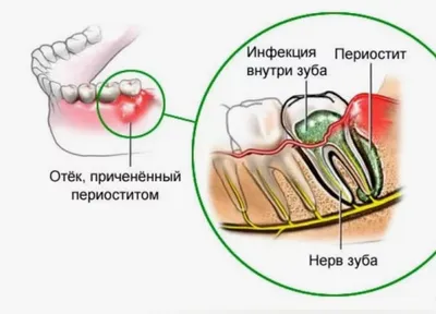 Периостит: симптомы и лечение, цены на лечение флюса в стоматологии -  Анле-Дент