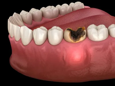 Протезирование и лечение зубов при дисфункции ВНЧС