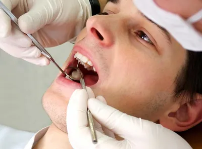 Периостит (воспаление надкостницы зуба) — причины, виды, 7 симптомов и  лечение | Dental Art