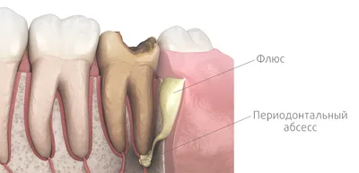 Свищ на десне: причины, как выявить и что делать? - DentBerg