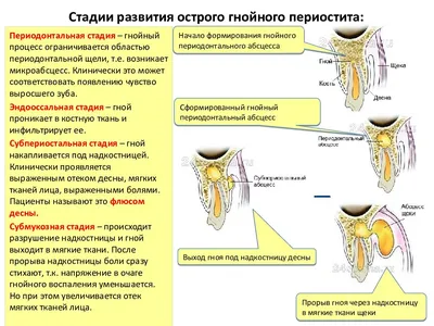 Острый и хронический флюс (периостит) и методы его лечения