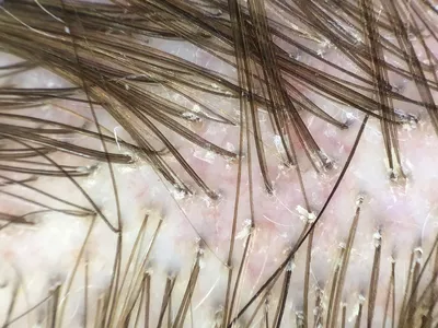 Перхоть на бровях: почему шелушится кожа и как от этого избавиться, причины  и лечение себорейного дерматита и грибка на бровях