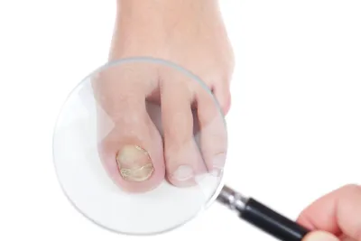 Быстрое и эффективное избавление от грибка ногтей на руках | Огрибках.ру -  Онлайн журнал | Дзен