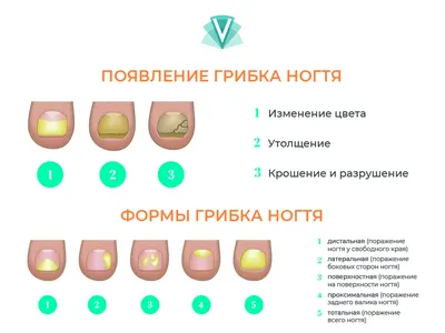 Грибок ногтей: симптомы, признаки и причины появления грибка на ногтях