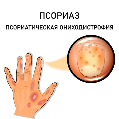 Грибок ногтей на руках | Вылечим грибок на пальцах рук в Москве, Крылатское  | Подология