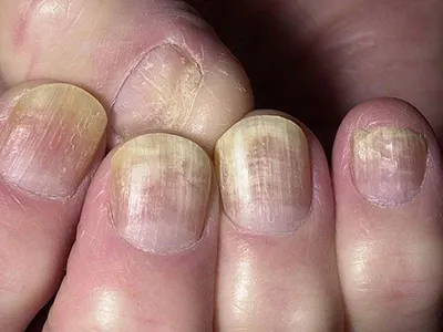 Грибок ногтей: симптомы, диагностика и лечение — Медицинская лаборатория IMD