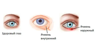 Ячмень на глазу у взрослых и детей: лечение, причины, стадии, признаки и  симптомы