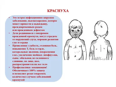 Детские инфекции: краснуха – в чем ее причины, как проявляется и как ее  нужно лечить | О детском здоровье: с врачебного на родительский | Дзен