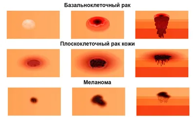 Меланома кожи: фото, стадии, симптомы. Лечение меланомы, диагностика