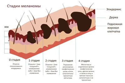 Симптомы меланомы Чаще всего опухоль возникает из уже имеющейся на коже  родинки. Признаки ее перерождения в онкологию легко запомнить по… |  Instagram