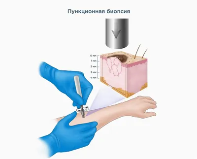 Рак кожи: первые признаки - ToBeWell