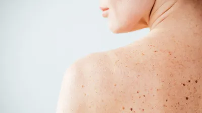 Как определить рак кожи: симптомы и признаки возможной онкологии кожи