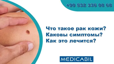 Лечение рака кожи в Москве - диагностика рака кожи в частной клинике  \"ВитаМед\".