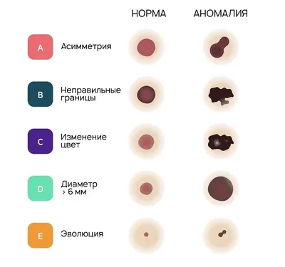 В России разработали способ эффективной ранней диагностики рака кожи