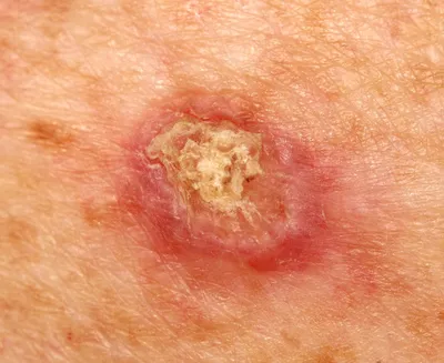 Симптомы рака кожи: на какие признаки стоит обратить внимание | Влад Светоч  | Дзен