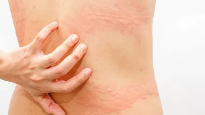 Рак кожи - первые признаки и лечение | ЯЗдоровье | Дзен