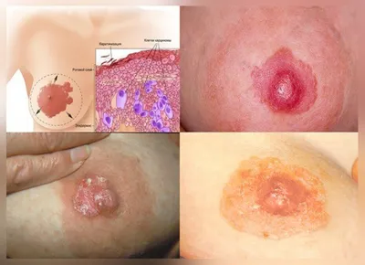 Рак кожи - диагностика, лечение | Онкологические заболевания кожи и мягких  тканей