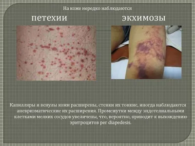 Точечные кровоизлияния на коже 3 - Диагностическое значение различных  изменений кожного покрова и слизистых оболочек - Судебная медицина от  Forens.ru