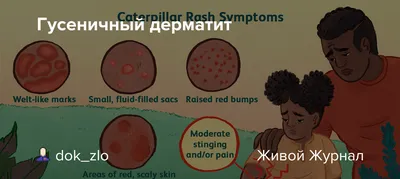 Цирроз печени: причины, признаки, симптомы и лечение