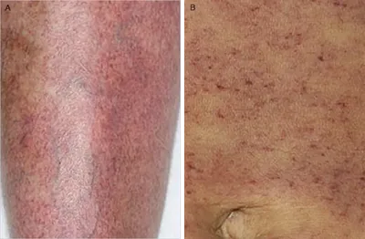 Сыпь на коже, на теле — Derma.ua