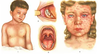 Корь: симптомы, фото, у детей и взрослых, прививка, лечение
