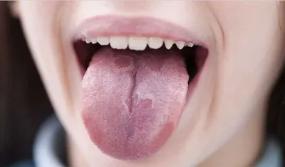 Розовое пятно на языке у ребенка: причины, симптомы и методы лечения