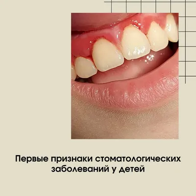 Врач-стоматолог рассказала – почему у ребенка меняется цвет языка,  образуются пятна и язвочки | О детском здоровье: с врачебного на  родительский | Дзен