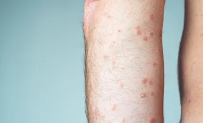 Недостаток кожи Аллергия на кожу Болезнь Уртикарии Красные пятна на коже  Стоковое Фото - изображение насчитывающей болезнь, изображение: 158916868