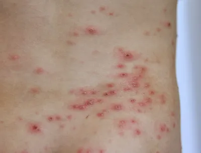 Аллергия на коже - красные пятна чешутся, лечение (фото) | Анютины глазки,  Пятна, Кожа