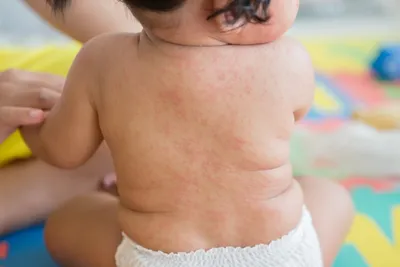 Сыпь на коже и аллергия ребенка с красной причиной пятна Стоковое Фото -  изображение насчитывающей заболевание, укуса: 182228500