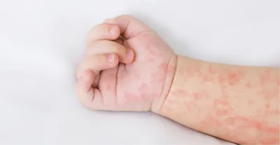 Красные щеки и сыпь на теле у ребенка: это аллергия или инфекция? -  Рамблер/женский