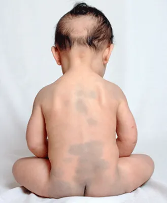 Белые пятна на теле у ребенка | Здоровье, красота, семья! | Дзен