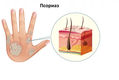 Псориаз - причины, симптомы, диагностика, лечение и профилактика