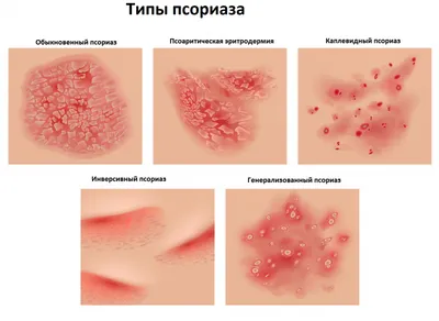 Псориаз - MDI Clinic