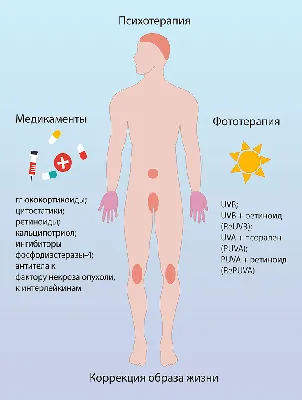 Лечение псориаза в СЗАО (м.Щукинская, м.Стрешнево, м.Сокол)